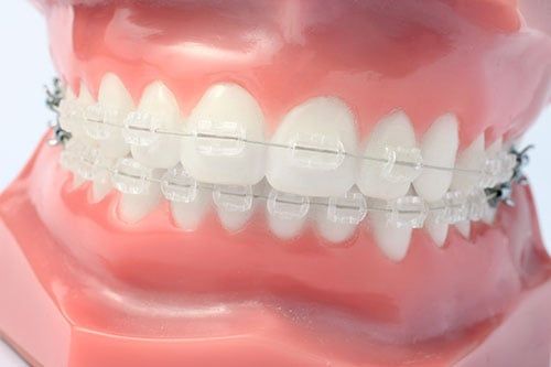 Ask Your Fort Worth Dentist: Should I Get Metal or Clear Braces? Archstone  Dental & Orthodontics, TX